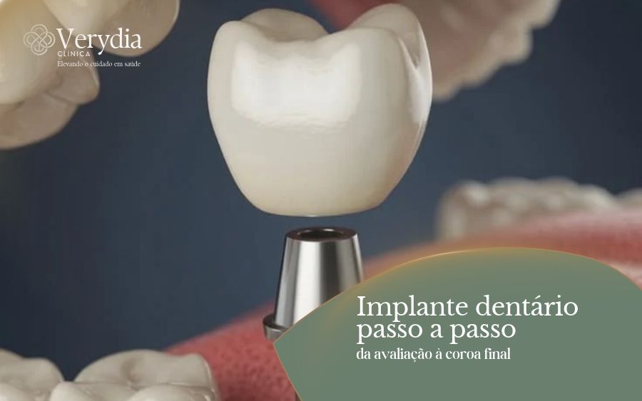 Implante dentário passo a passo: ilustração da coroa e do componente do implante na Verydia